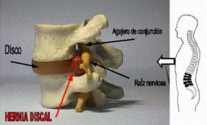 Hernia discal