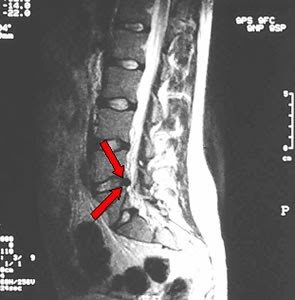 Hernia discal