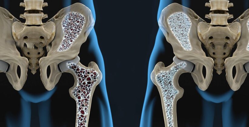 La osteoporosis provoca la disminución del tejido óseo,