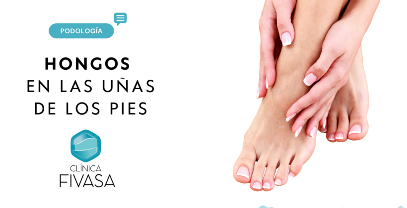 Hongos en las uñas de los pies, qué son y cómo tratarlos