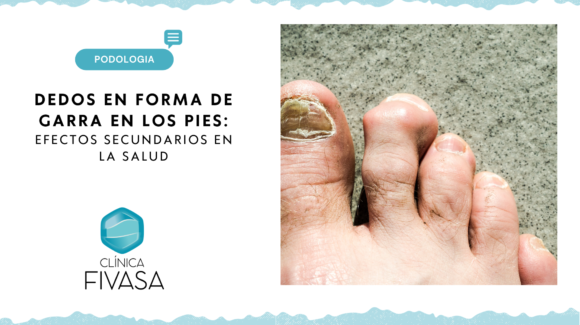 Dedos en Forma de Garra en los Pies: Una Perspectiva Médica