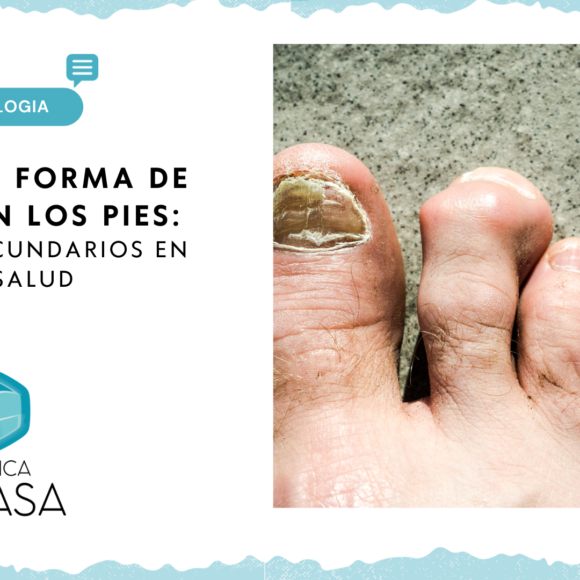 Dedos en Forma de Garra en los Pies: Una Perspectiva Médica