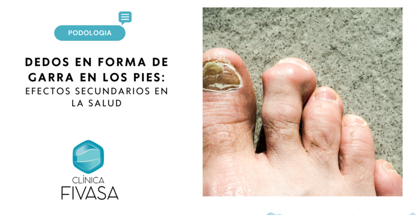 Dedos en Forma de Garra en los Pies: Una Perspectiva Médica